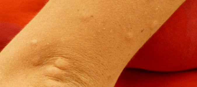 Mosquito bites in Texas